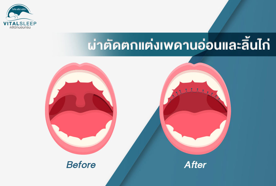 ผ่าตัดกแต่งเพดานอ่อนและลิ้นไก่