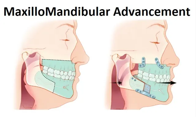 Maxillo-Mandibular-Advancement_Compare Maxillo-Mandibular-Advancement_Compare