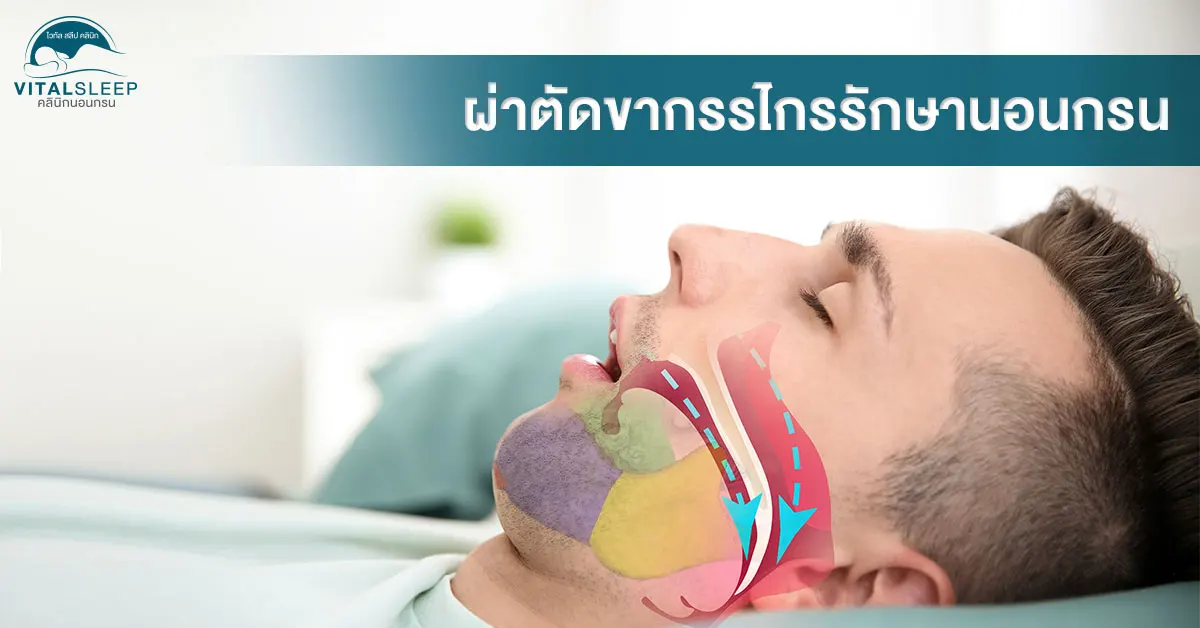 treat snoring with jaw surgery