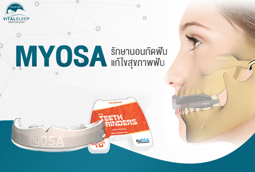 รักษานอนกัดฟันและข้อต่อขากรรไกรอักเสบได้ด้วย Myosa®