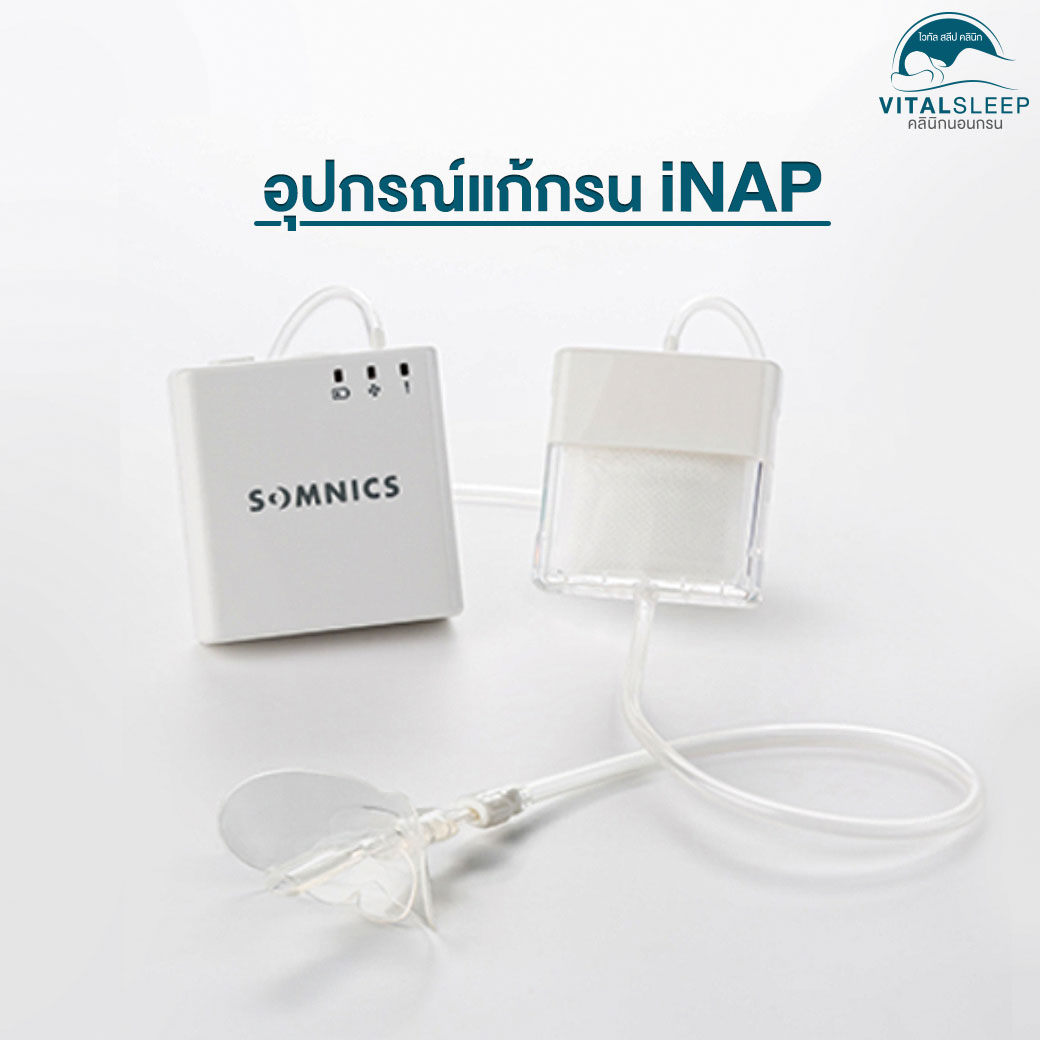 เครื่องมือแก้นอนกรน iNAP สามารถรักษาการนอนกรนโดยไม่ต้ องพึ่งการผ่าตัดแก้กรนโดยมีลักษ ณะคล้ายรีเทนเนอร์