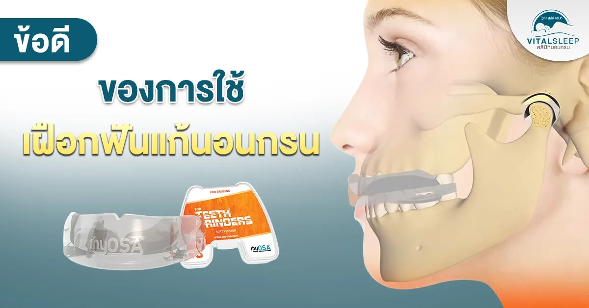ข้อดีของการใช้เฝือกฟันแก้นอนกรน